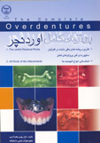 پروتزهاي كامل اوردنچر